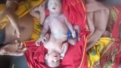 Conjoined Twins