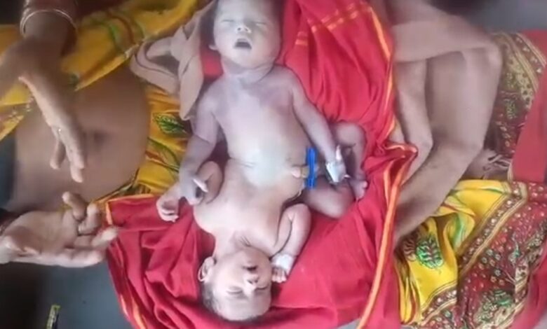 Conjoined Twins